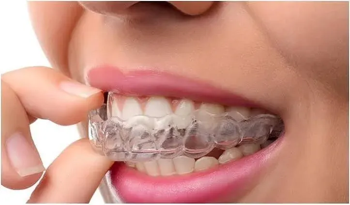 A clear aligner being fitted over the upper teeth