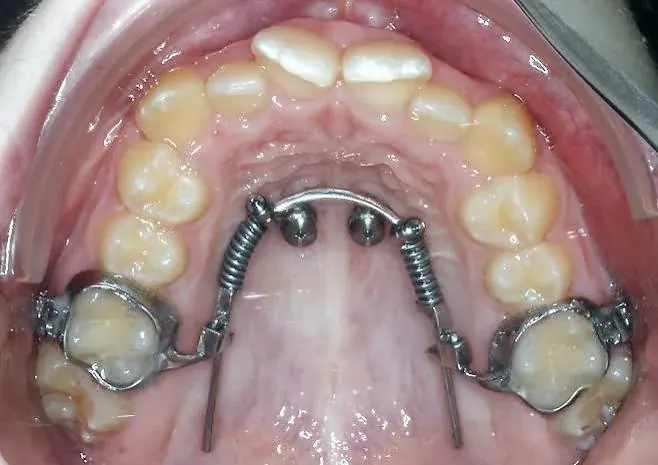 A Beneslider appliance anchored in the palate for molar distalisation