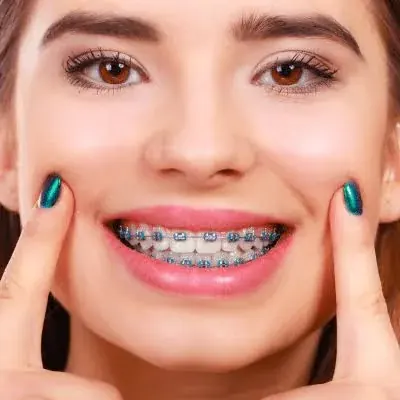 Fixed orthodontic braces in place on the upper and lower teeth