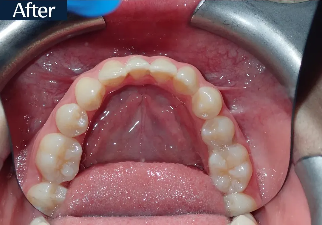 After treatment: intraoral view from case 1, treated by Dr. Moaiyad Pacha