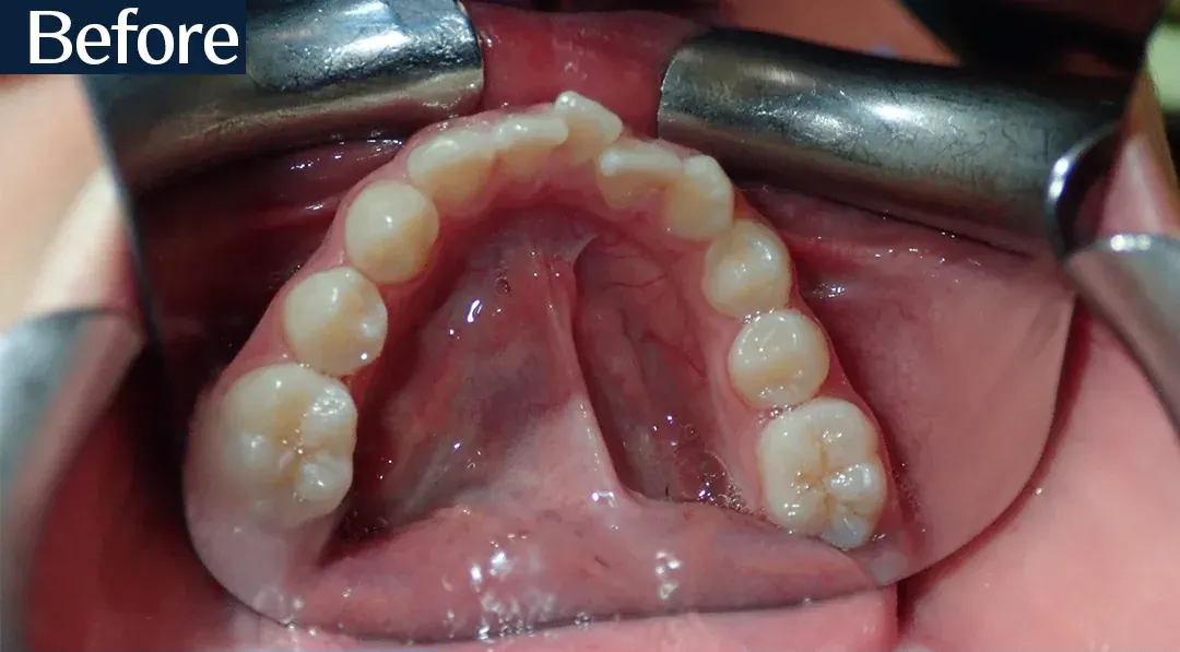 Before treatment: intraoral view from case 1, treated by Dr. Moaiyad Pacha