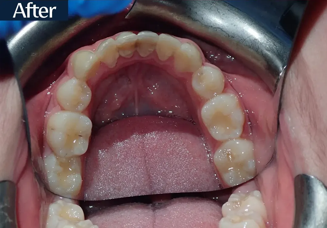 After treatment: intraoral view from case 2, treated by Dr. Moaiyad Pacha