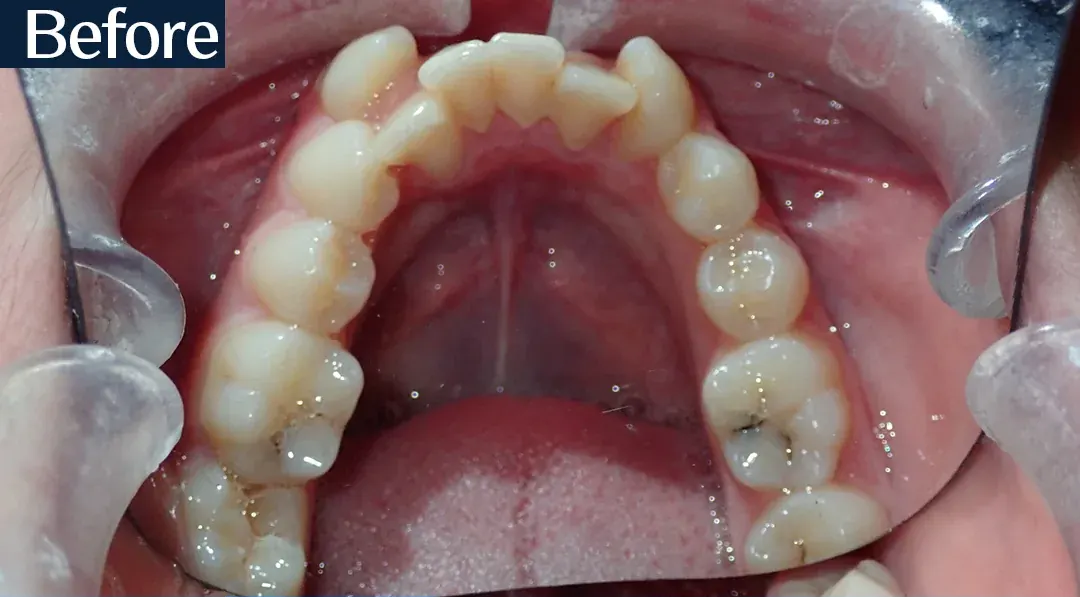 Before treatment: intraoral view from case 2, treated by Dr. Moaiyad Pacha