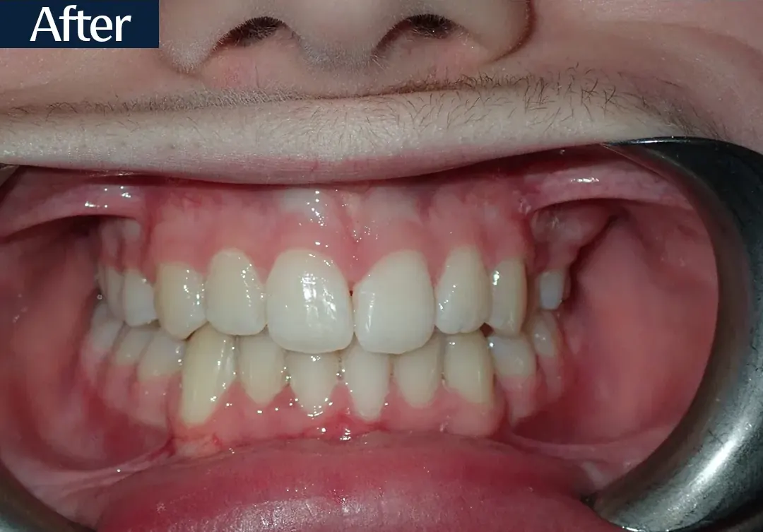 After treatment: intraoral view from case 3, treated by Dr. Moaiyad Pacha