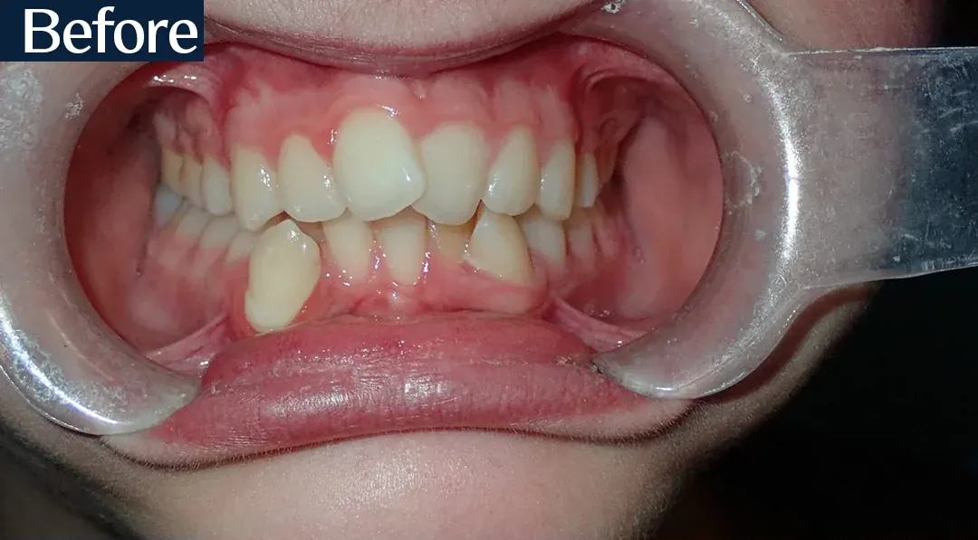 Before treatment: intraoral view from case 3, treated by Dr. Moaiyad Pacha