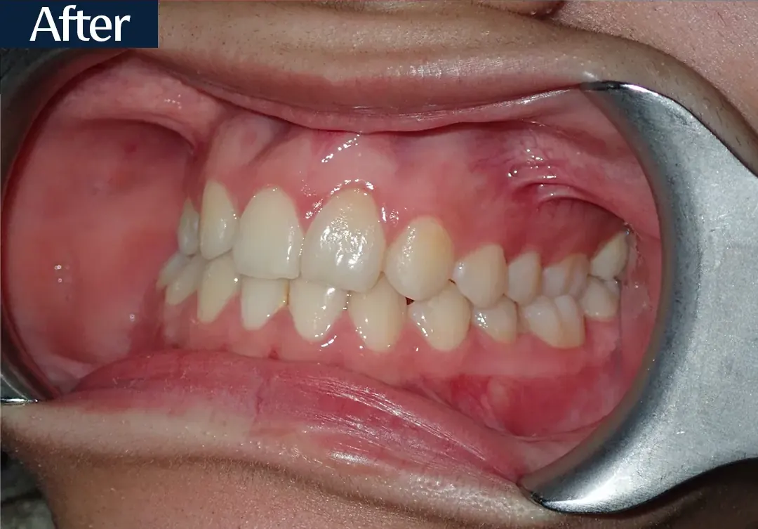 After treatment: intraoral view from case 4, treated by Dr. Moaiyad Pacha
