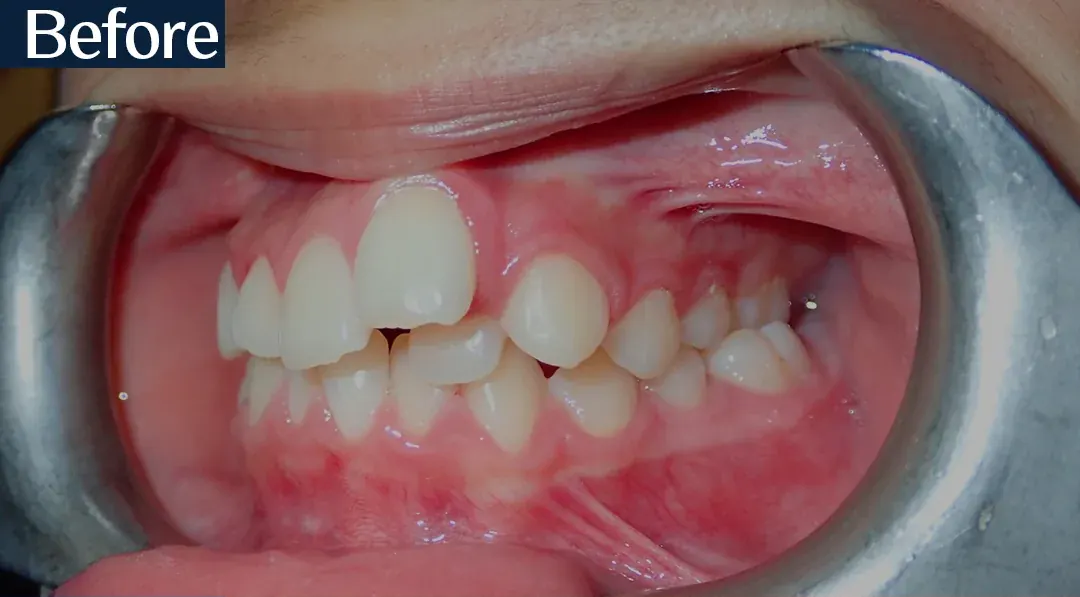 Before treatment: intraoral view from case 4, treated by Dr. Moaiyad Pacha