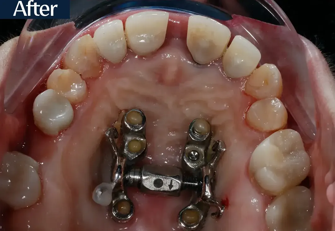 After treatment: intraoral view from case 5, treated by Dr. Moaiyad Pacha