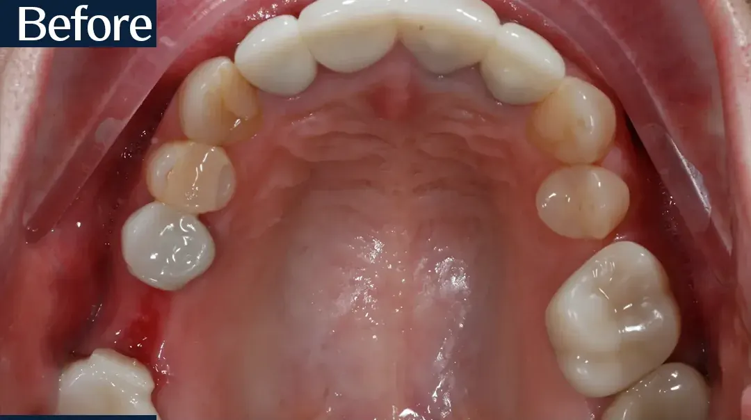 Before treatment: intraoral view from case 5, treated by Dr. Moaiyad Pacha