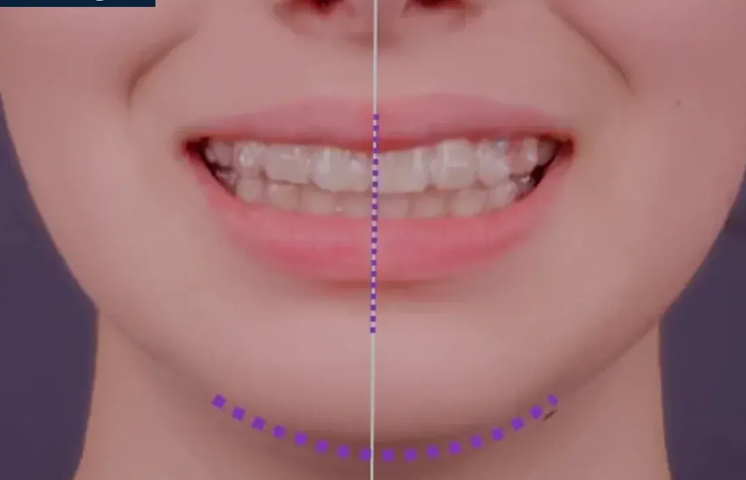 After treatment: intraoral view from case 6, treated by Dr. Moaiyad Pacha