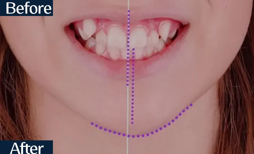 Before treatment: intraoral view from case 6, treated by Dr. Moaiyad Pacha