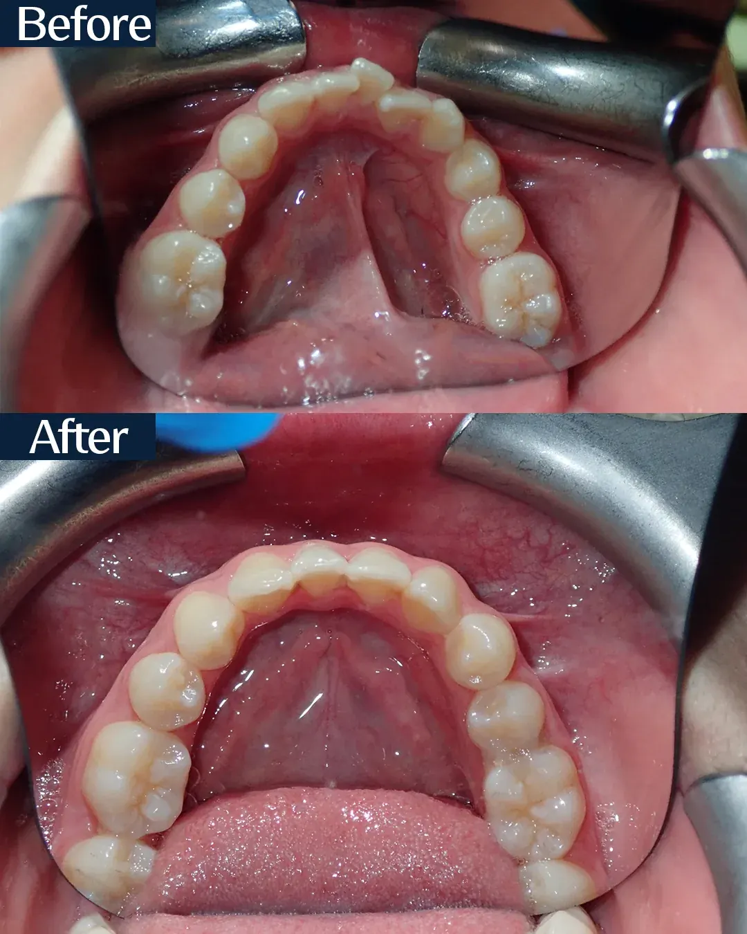 Palatal arch before and after miniscrew-assisted expansion, case 1, treated by Dr. Moaiyad Pacha