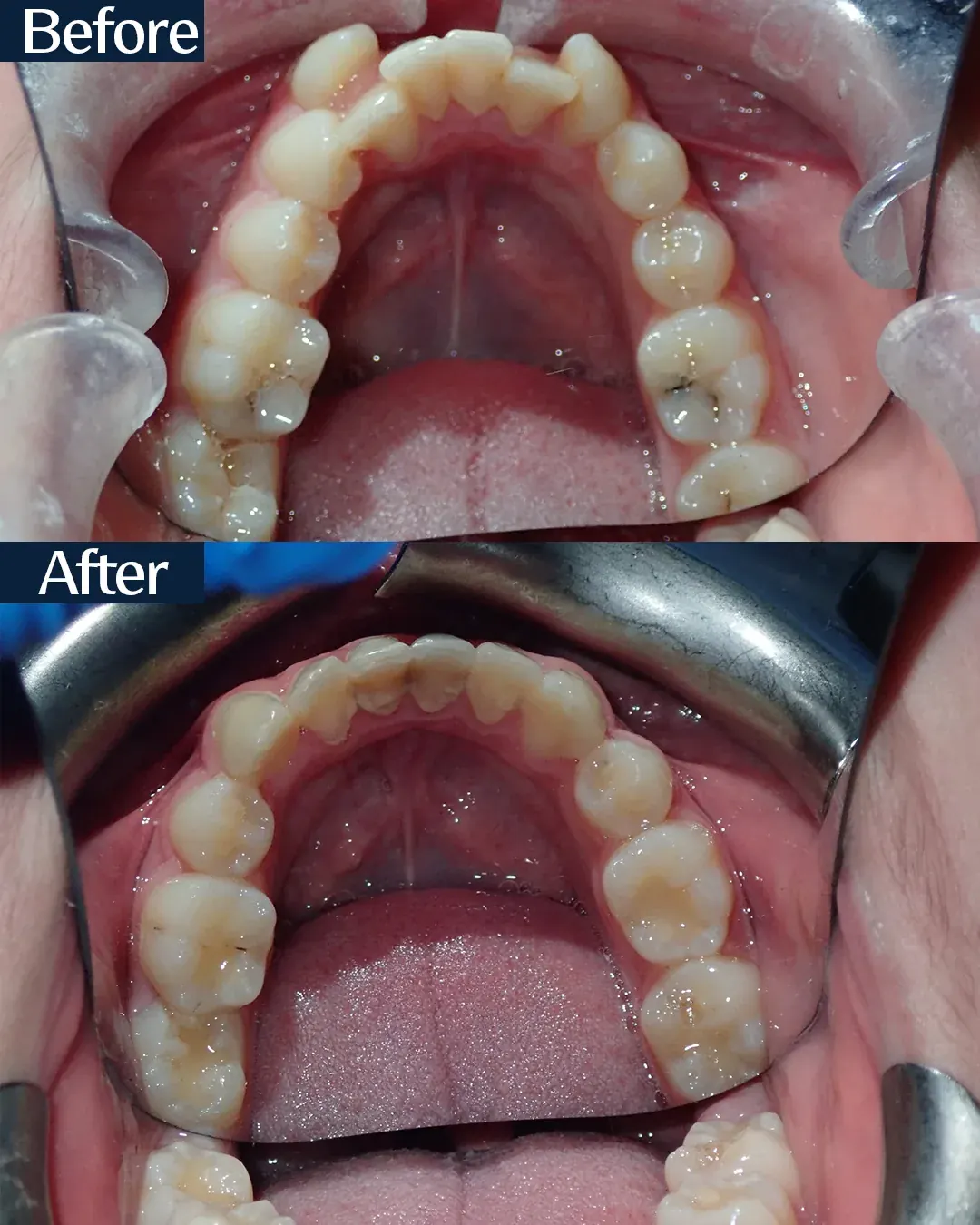 Palatal arch before and after miniscrew-assisted expansion, case 2, treated by Dr. Moaiyad Pacha