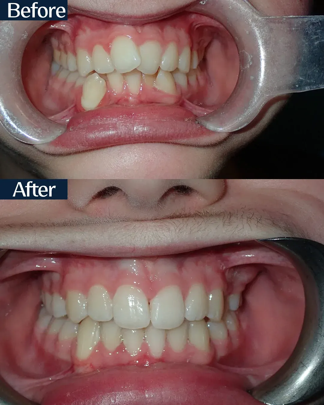 Upper and lower arches before and after orthodontic treatment, case 3, treated by Dr. Moaiyad Pacha