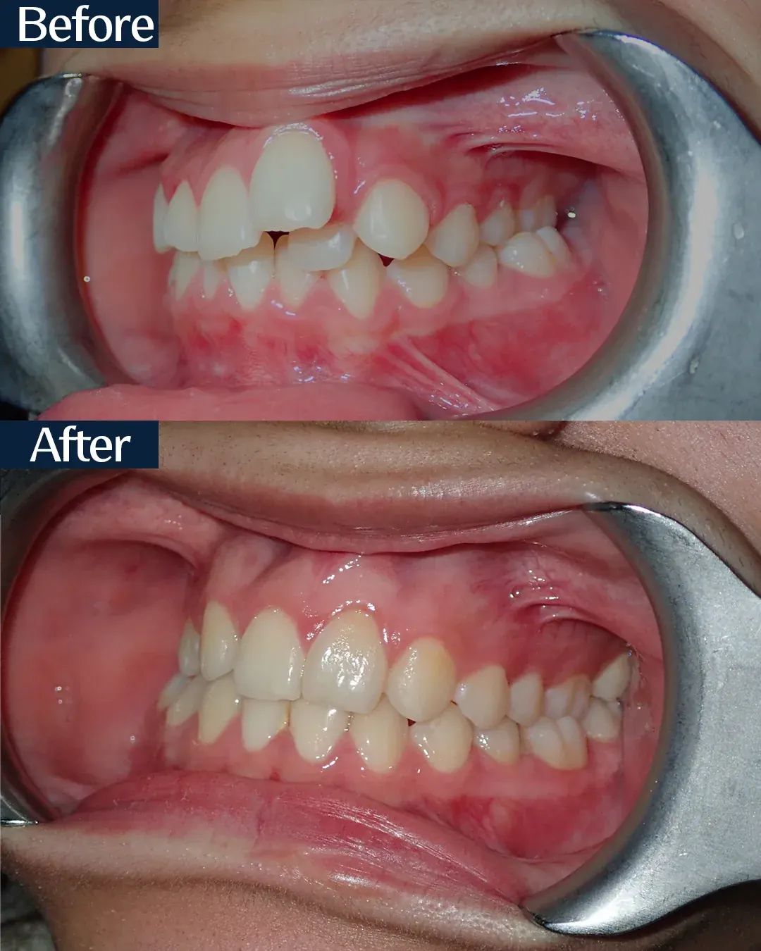 Palatal arch before and after miniscrew-assisted expansion, case 4, treated by Dr. Moaiyad Pacha