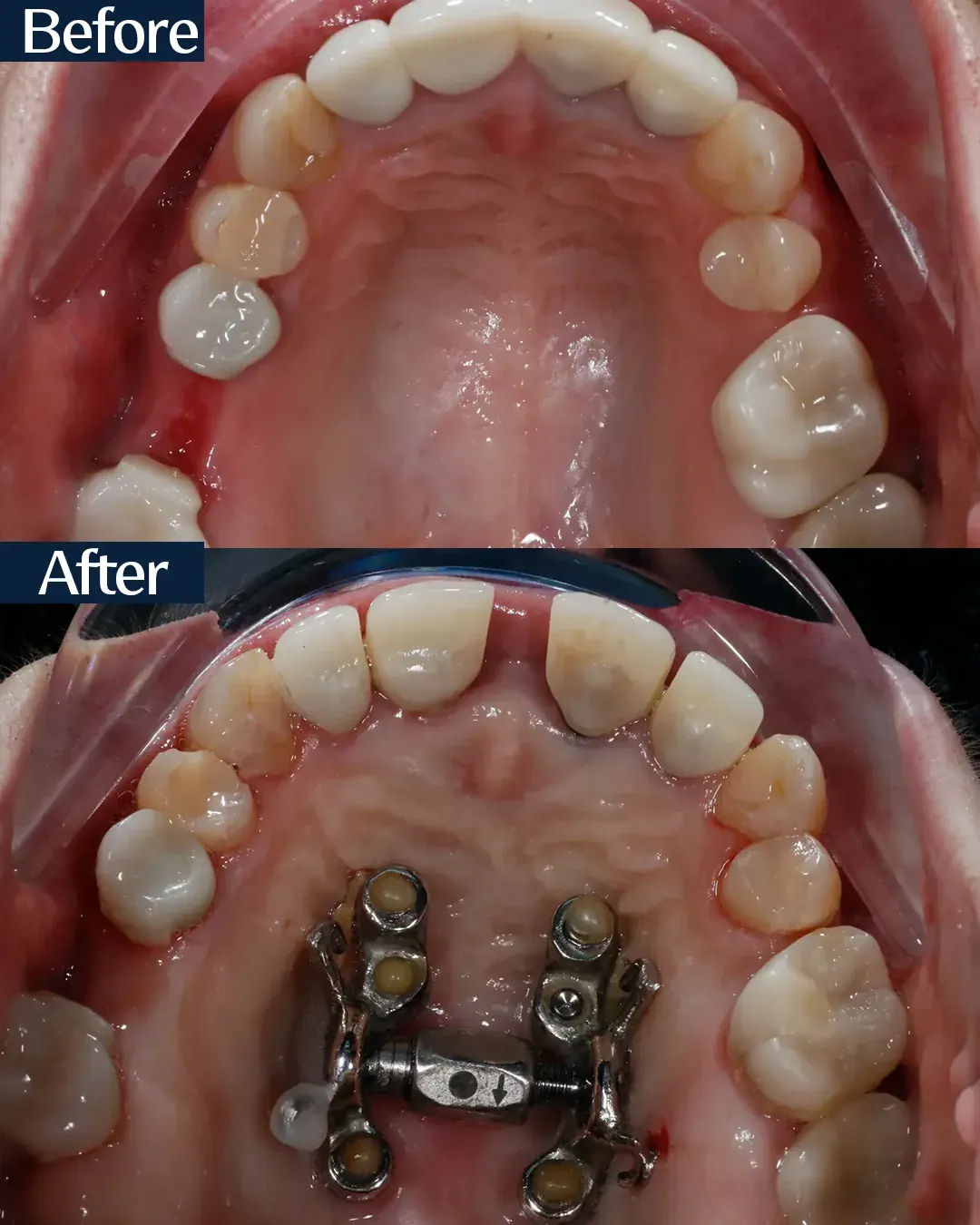 Palatal arch before and after miniscrew-assisted expansion, case 5, treated by Dr. Moaiyad Pacha