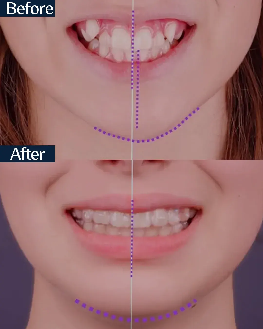 Frontal view of the smile before and after treatment, case 6, treated by Dr. Moaiyad Pacha