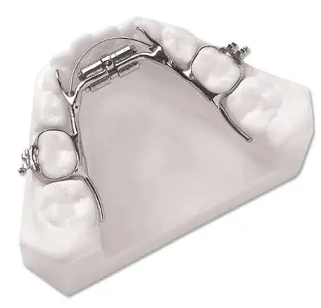 An expansion appliance on a dental model