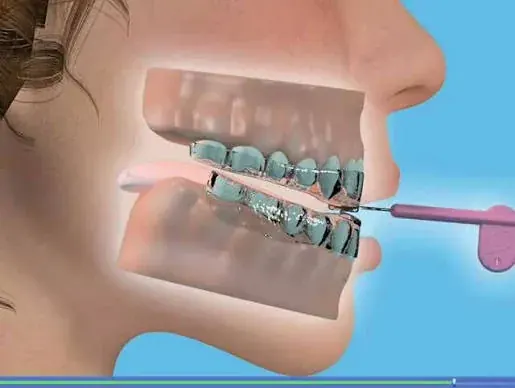 Illustration showing how advancing the lower jaw increases the space behind the tongue