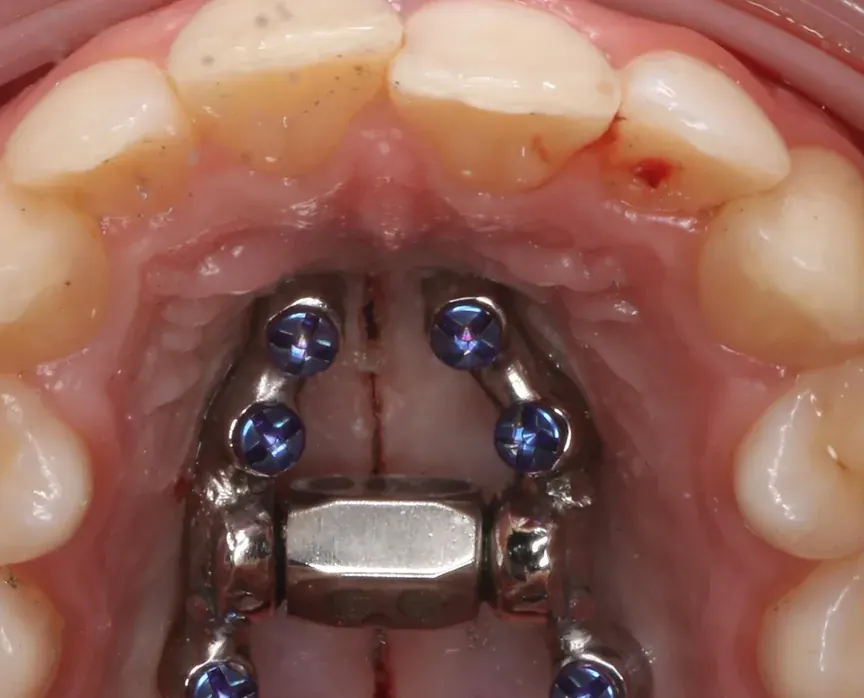 Detail of the anchorage arms of a miniscrew-assisted expander where they meet the posterior teeth