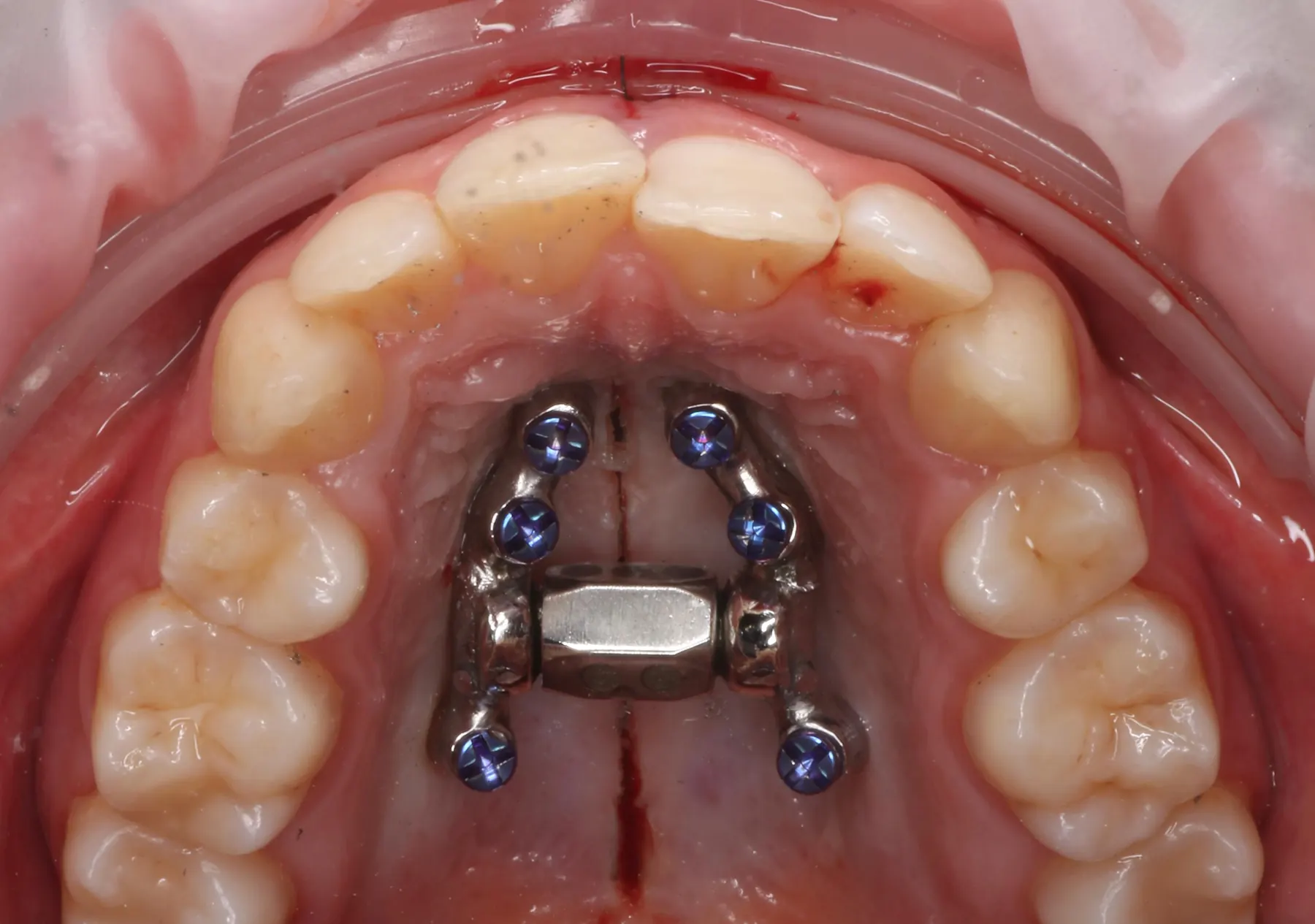 Wide intraoral view of the upper arch with a miniscrew-assisted palatal expander fitted across the palate