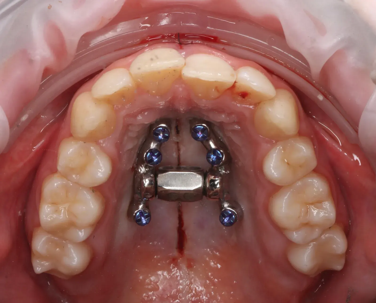 Close-up clinical photograph of a miniscrew-assisted rapid palatal expander fitted to the palate