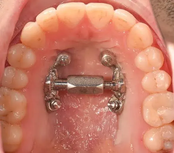 A palatal expansion appliance seated in the palate