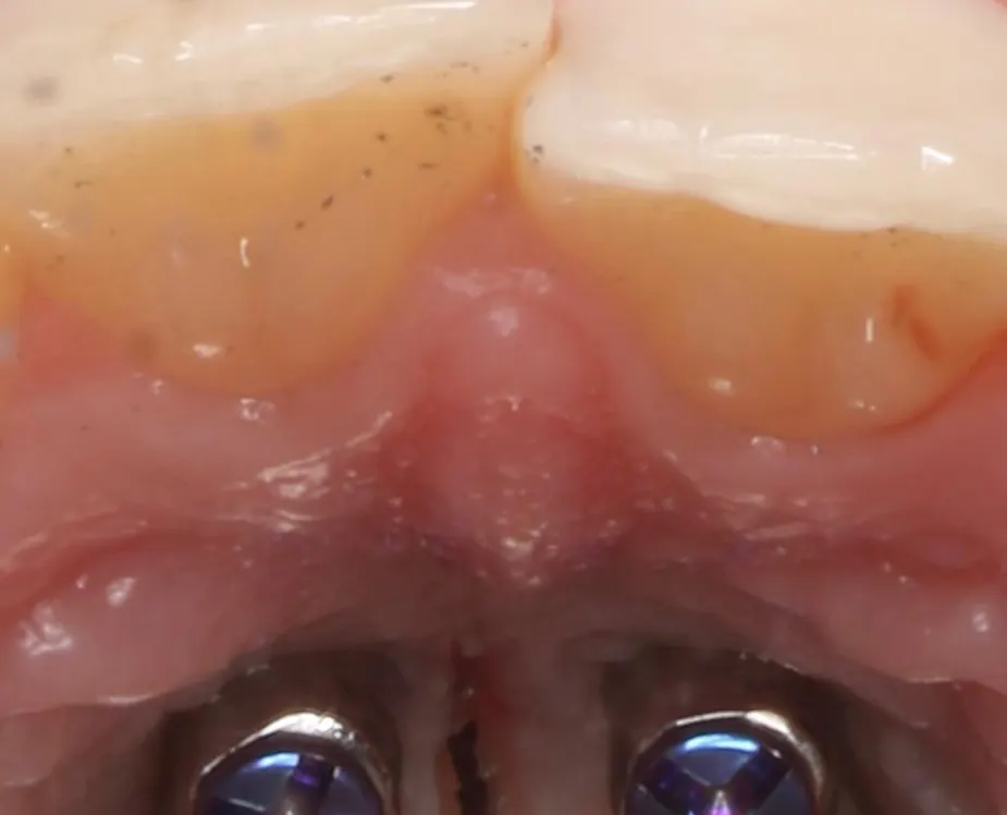 Close view of the miniscrews anchoring an expander into palatal bone