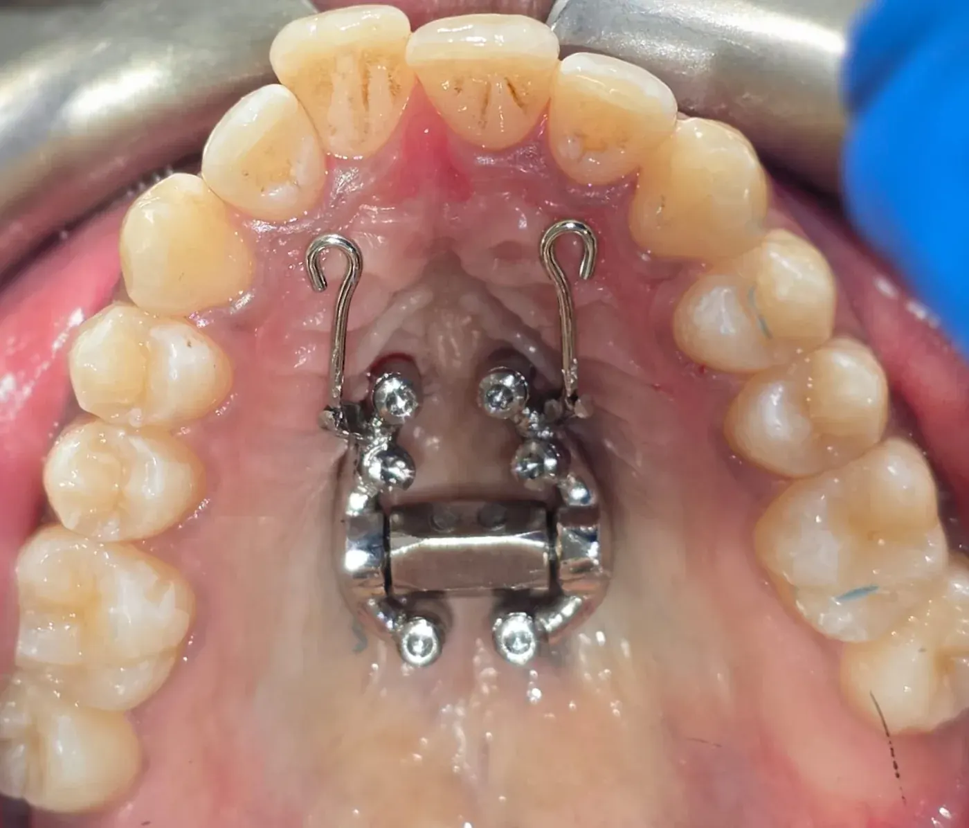 An expander fitted with anterior hooks for maxillary protraction