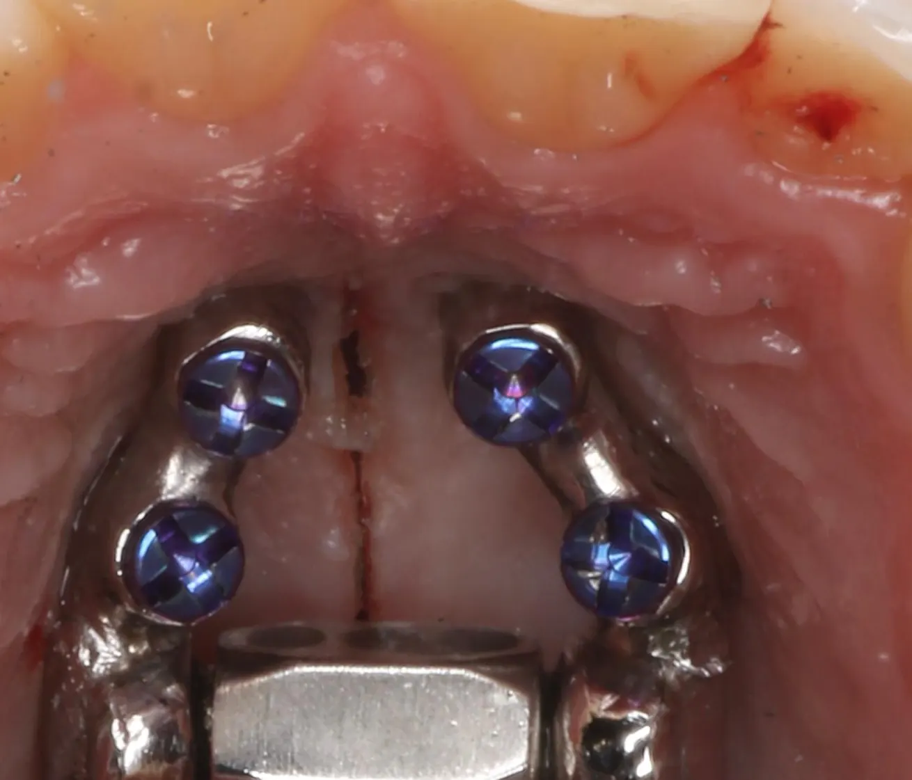 Close view of the central expansion screw of a palatal expander