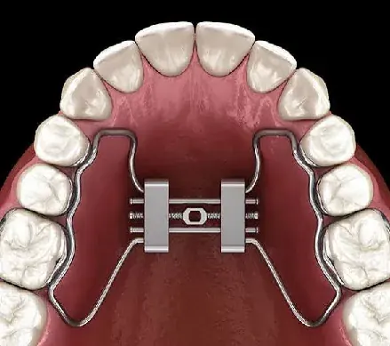 Three-dimensional illustration of a maxillary expander across the palate