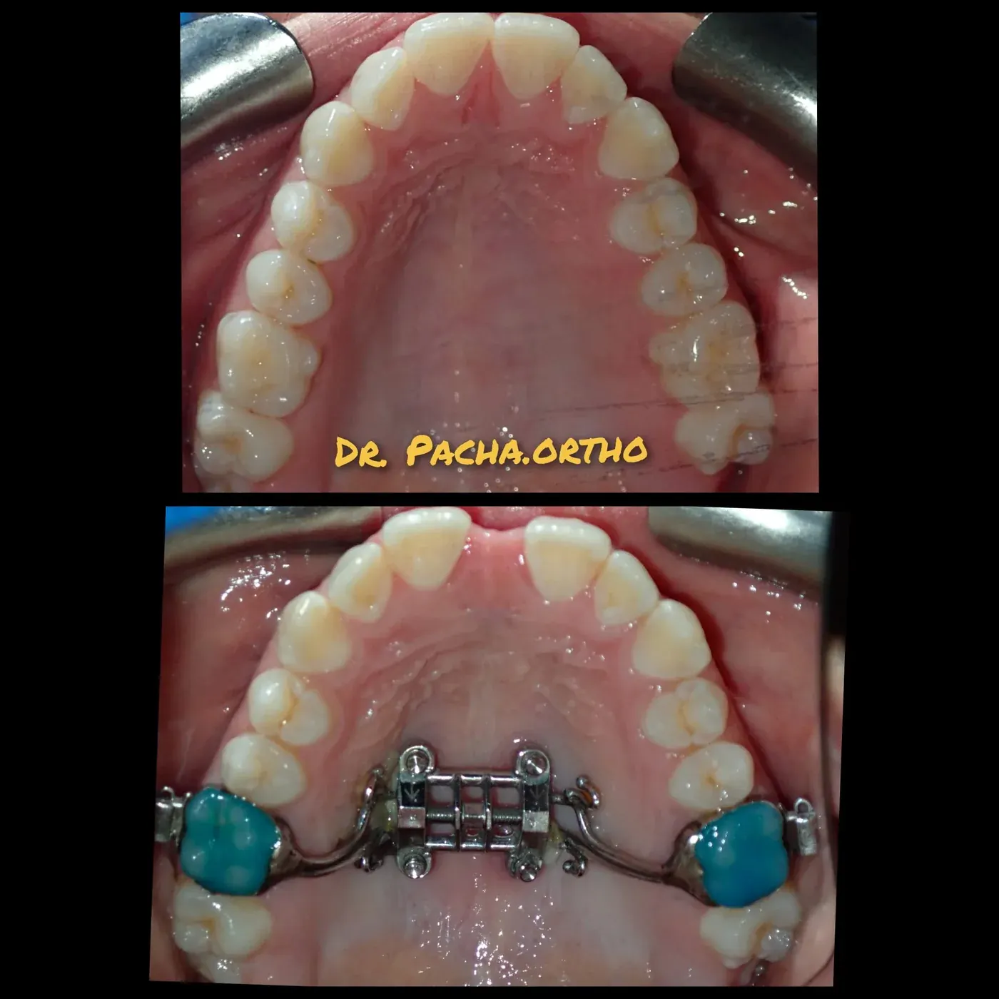 Intraoral view from a maxillary skeletal expansion case treated by Dr. Moaiyad Pacha