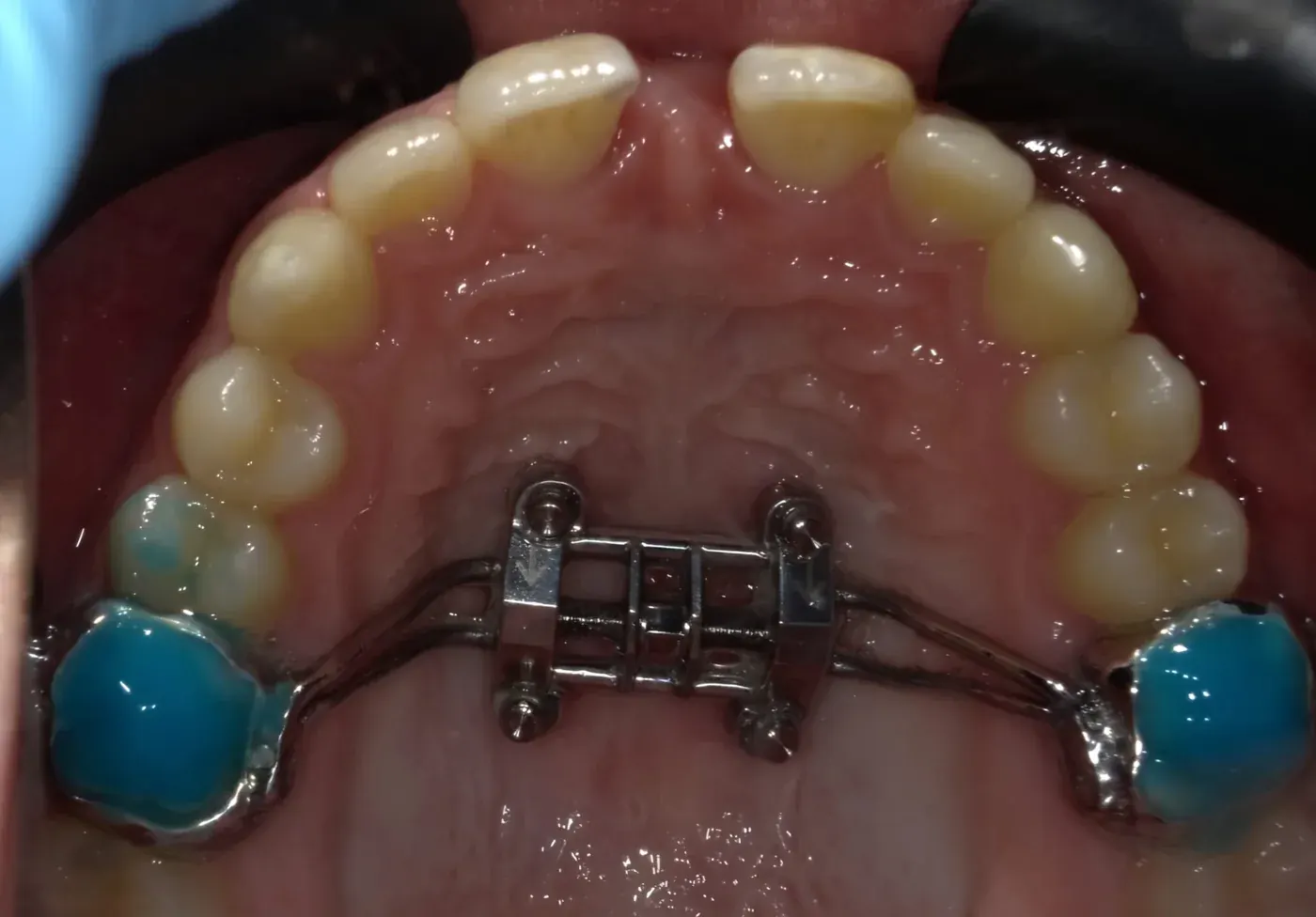 A maxillary skeletal expander in place, anchored by four palatal miniscrews