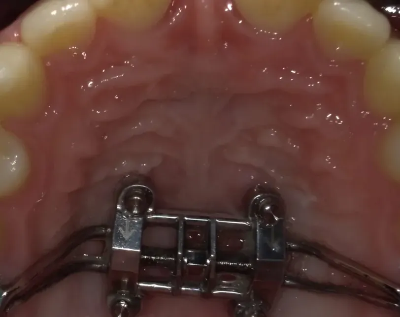 Detail of a maxillary skeletal expander seated against the palate