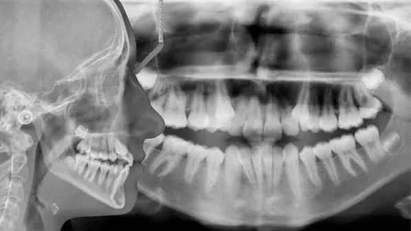 A panoramic radiograph showing both jaws, the teeth and developing teeth