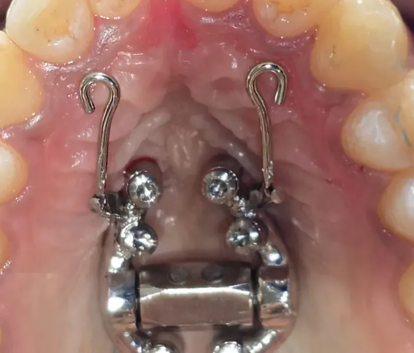 Detail of the anterior hooks used to apply maxillary protraction force