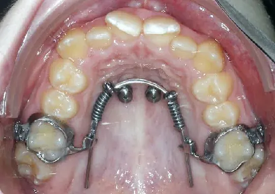 Intraoral view of temporary anchorage devices supporting non-extraction mechanics