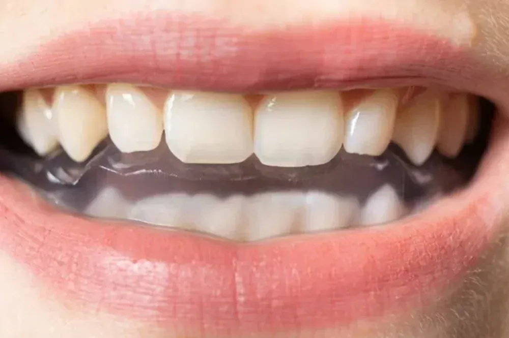 A discreet daytime occlusal orthotic worn on the lower teeth