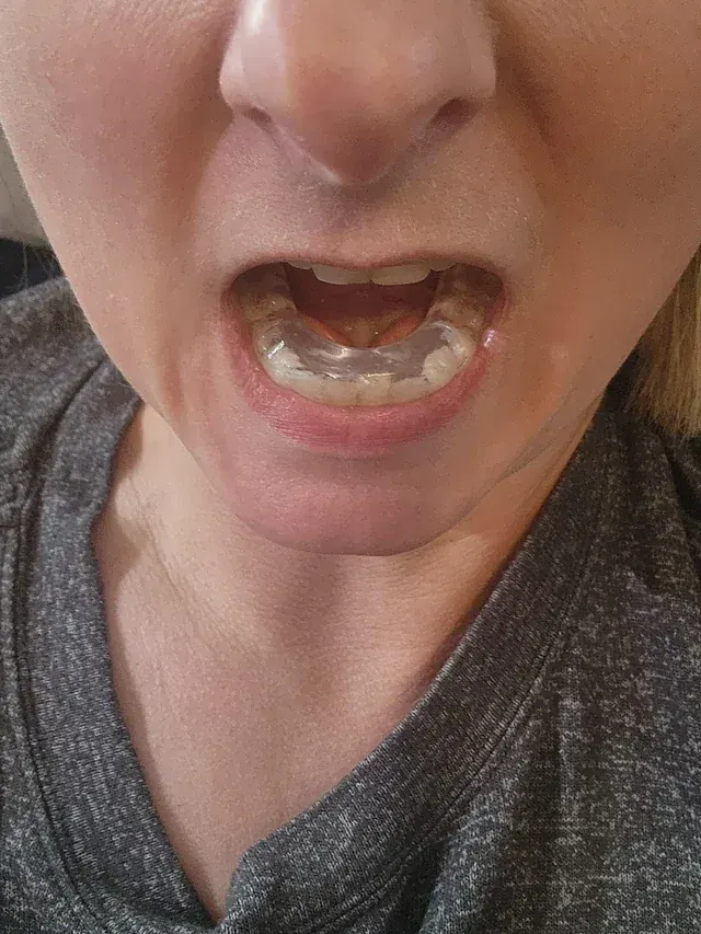 A clear full-coverage occlusal splint in place on the upper teeth