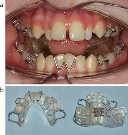 A twin block functional appliance on a dental model